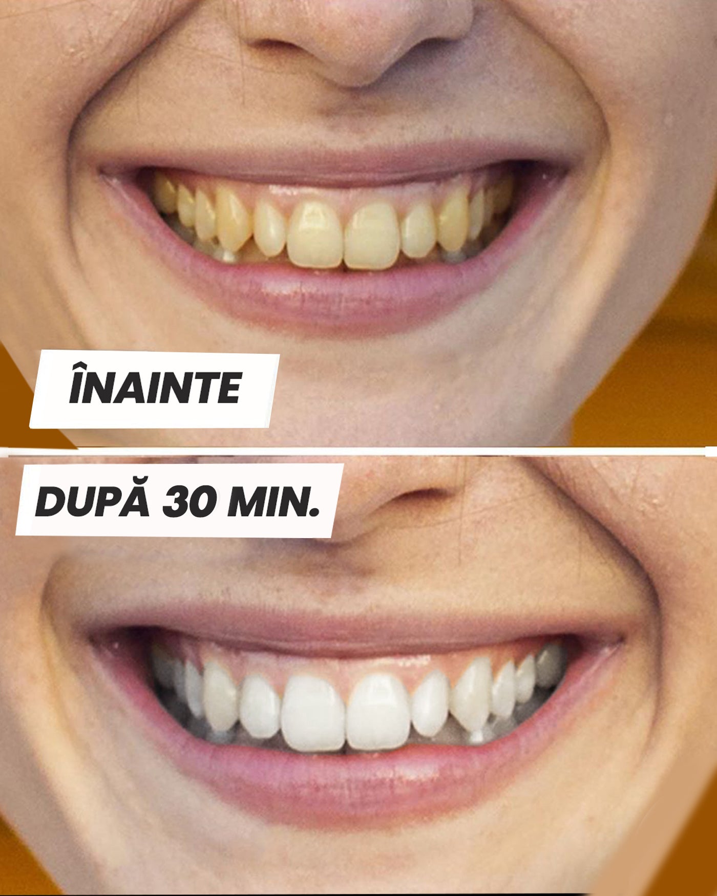 Benzi de albire a dinților - Mov