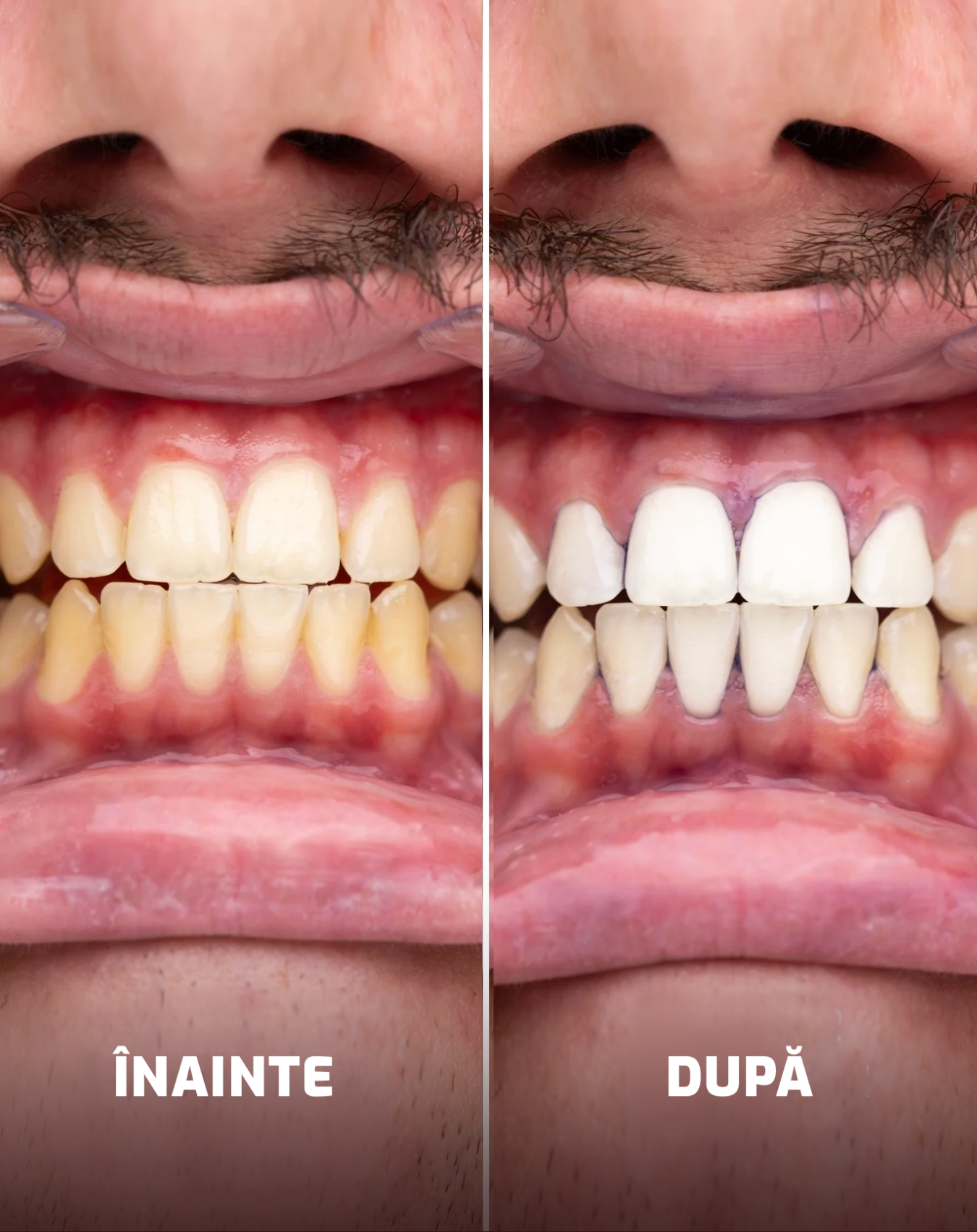 Benzi de albire a dinților - Mov